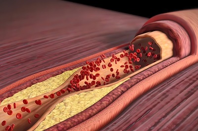 女性主动脉钙化要警惕 这些疾病正在危害身体健康